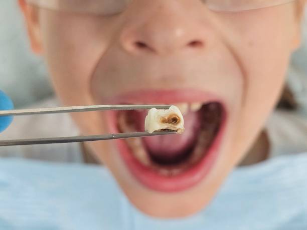 Best Emergency Dental Care for Broken or Chipped Teeth in Coleman, TX